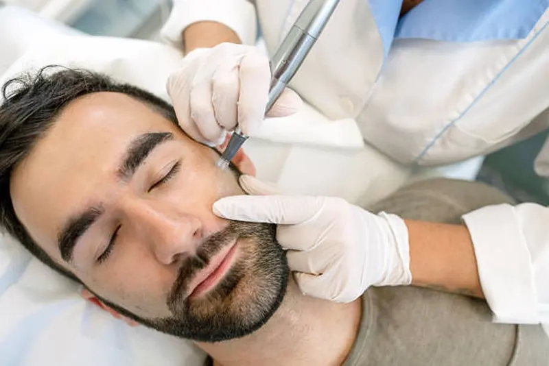 Dermapen behandling